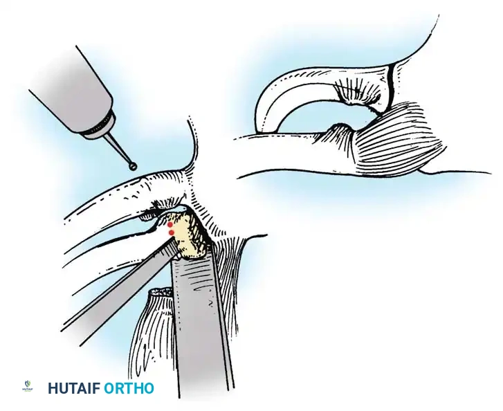 Operative Management of Sternoclavicular Joint Dislocations: A Comprehensive Guide
