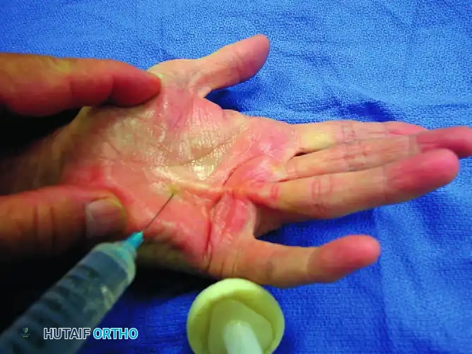 Subcutaneous Fasciotomy for Dupuytren Contracture