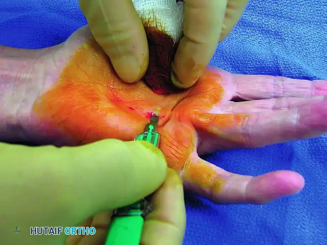 SUBCUTANEOUS FASCIOTOMY Surgical Diagram