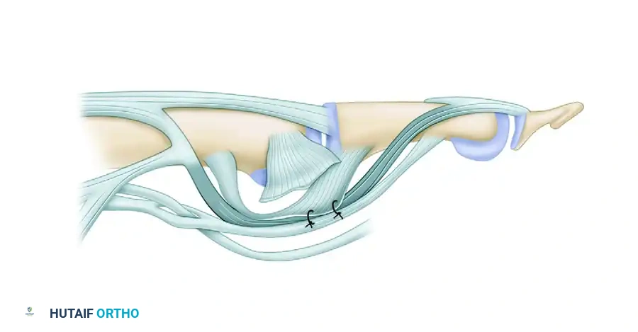 Sublimis Tenodesis & Lateral Band Translocation for PIP Joint