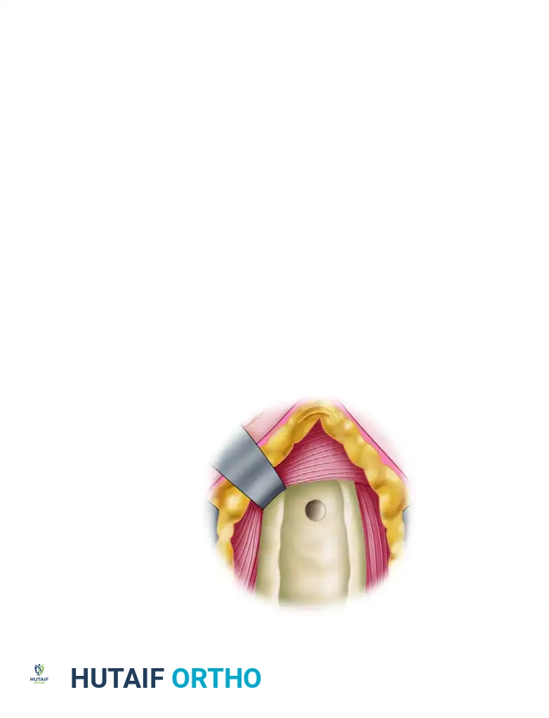 Composite Diagram of Subpectoral Tenodesis