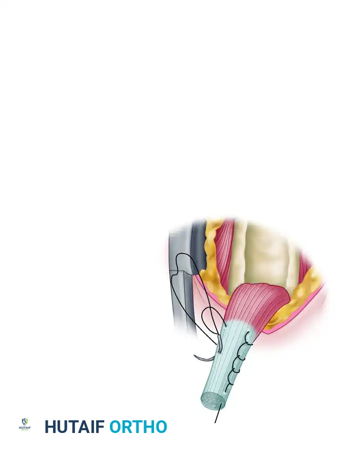 Biceps Tendon Pulled into Wound