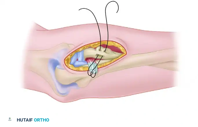 Two-Incision Technique - Tendon Passage