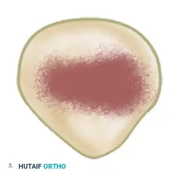 Chondromalacia Patellae and Subperiosteal Release of the Lateral Quadriceps Mechanism