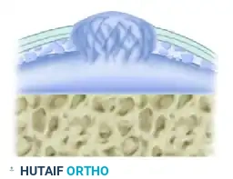 Fasciculation stage 2