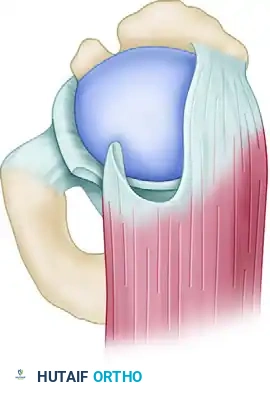 Basket punch inserted