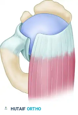 Completed interval slide release for crescentic tear