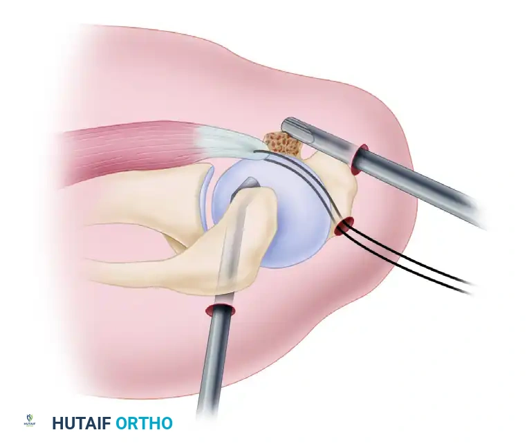 Preparation of bone bed