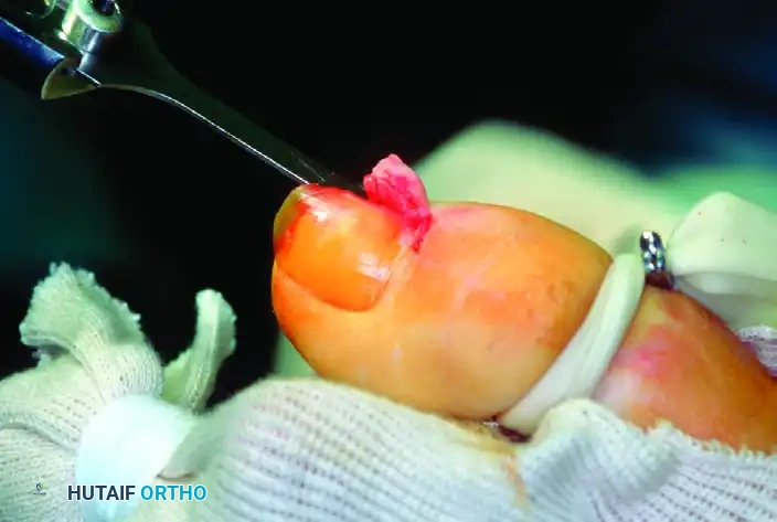 SUBUNGUAL AND PERIUNGUAL FIBROMAS Surgical Diagram