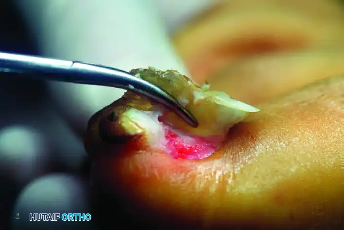 SUBUNGUAL AND PERIUNGUAL FIBROMAS Surgical Diagram