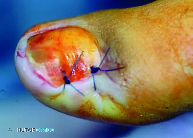 SUBUNGUAL AND PERIUNGUAL FIBROMAS Surgical Diagram