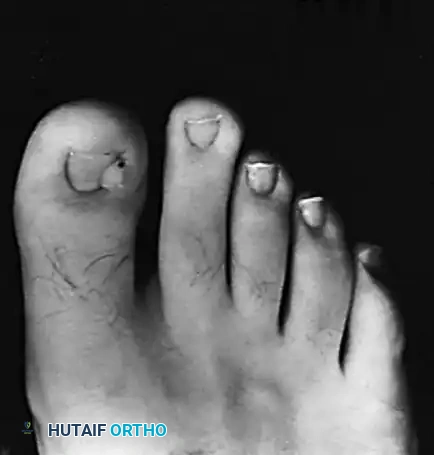 SUBUNGUAL AND PERIUNGUAL FIBROMAS Surgical Diagram