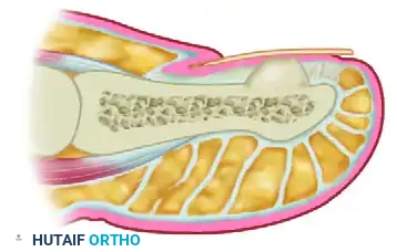 SUBUNGUAL AND PERIUNGUAL FIBROMAS Surgical Diagram
