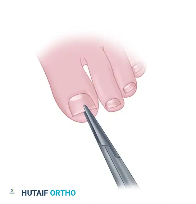 SUBUNGUAL AND PERIUNGUAL FIBROMAS Surgical Diagram