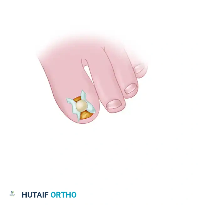 SUBUNGUAL AND PERIUNGUAL FIBROMAS Surgical Diagram