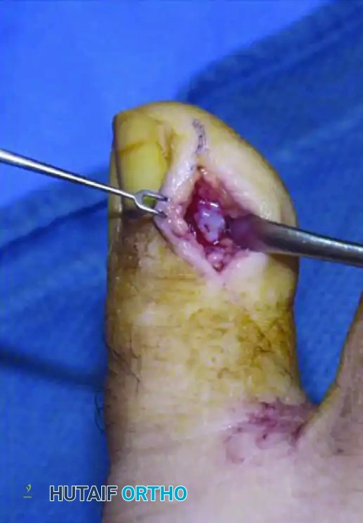 SUBUNGUAL AND PERIUNGUAL FIBROMAS Surgical Diagram
