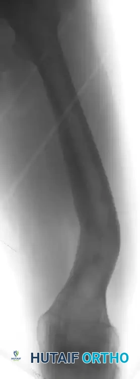 Comprehensive Management of Femoral Malunions: Supracondylar and Diaphyseal Strategies