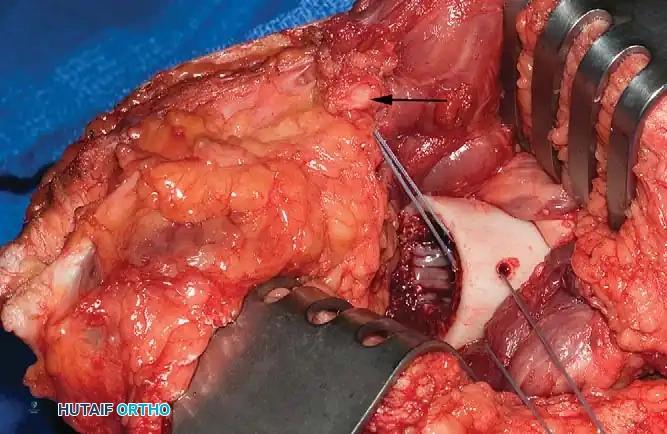 Fig. 9-3 Myodesis in transfemoral amputation. Adductor magnus tendon (arrow) is pulled into cut end of distal femur and secured through drill hole in lateral cortex.