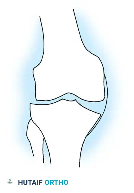 Fig. 6-52 After osteophyte resection, knee passively corrects to normal alignment. (From Barnes CL, Scott RD: Unicompartmental knee arthroplasty, Instr Course Lect 42:309, 1993.)