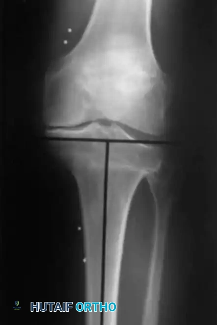 Fig. 6-53 Frequently after high tibial osteotomy, lateral tibial bone deﬁ ciency is present because of valgus deformity of proximal tibia.