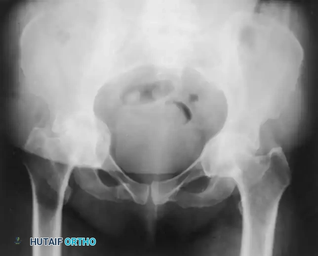Fig. 7-74 Primary protrusio acetabuli. Otto pelvis in 52-year-old woman. Femoral head has migrated medial to ilioischial (Kohler) line. Hip motion is severely limited.