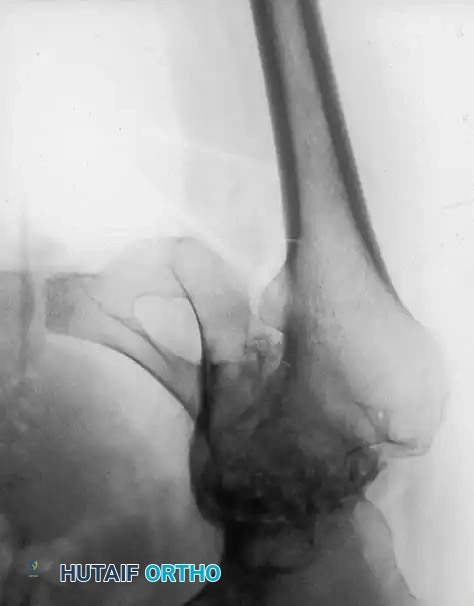 Fig. 7-75 Reconstruction for protrusio acetabuli deformity. B, After total hip arthroplasty. Hip center was restored to more lateral and inferior position. Large acetabular component allowed rim fixation without need for screws, and medial deficits were grafted with cancellous autograft from femoral head with excellent incorporation.