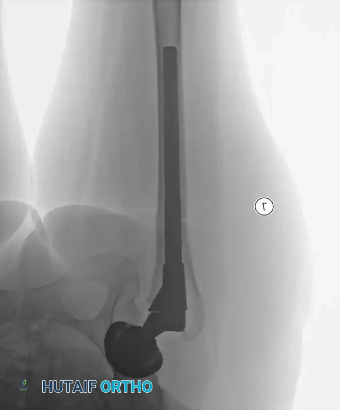 Long-term follow-up showing stable bone ingrowth without progressive radiolucencies.