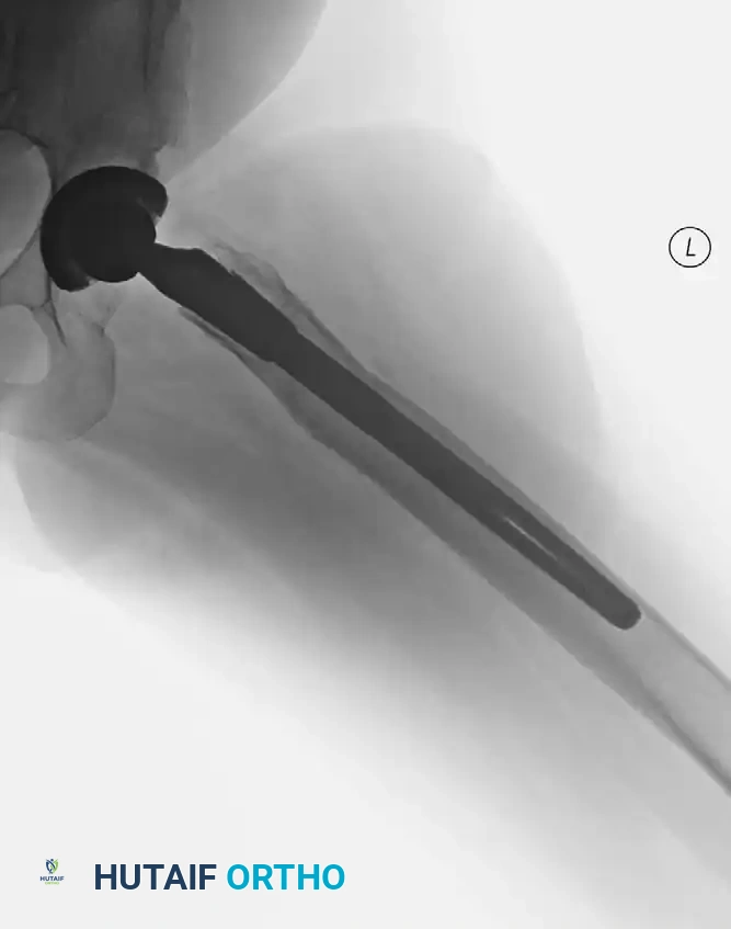 Assessment of the medial wall following osteophyte resection.