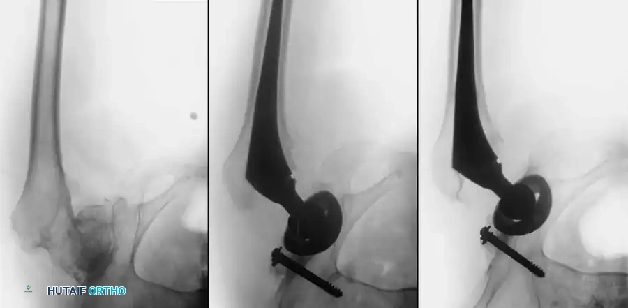 Preoperative templating demonstrating severe joint space narrowing and lateral subluxation.