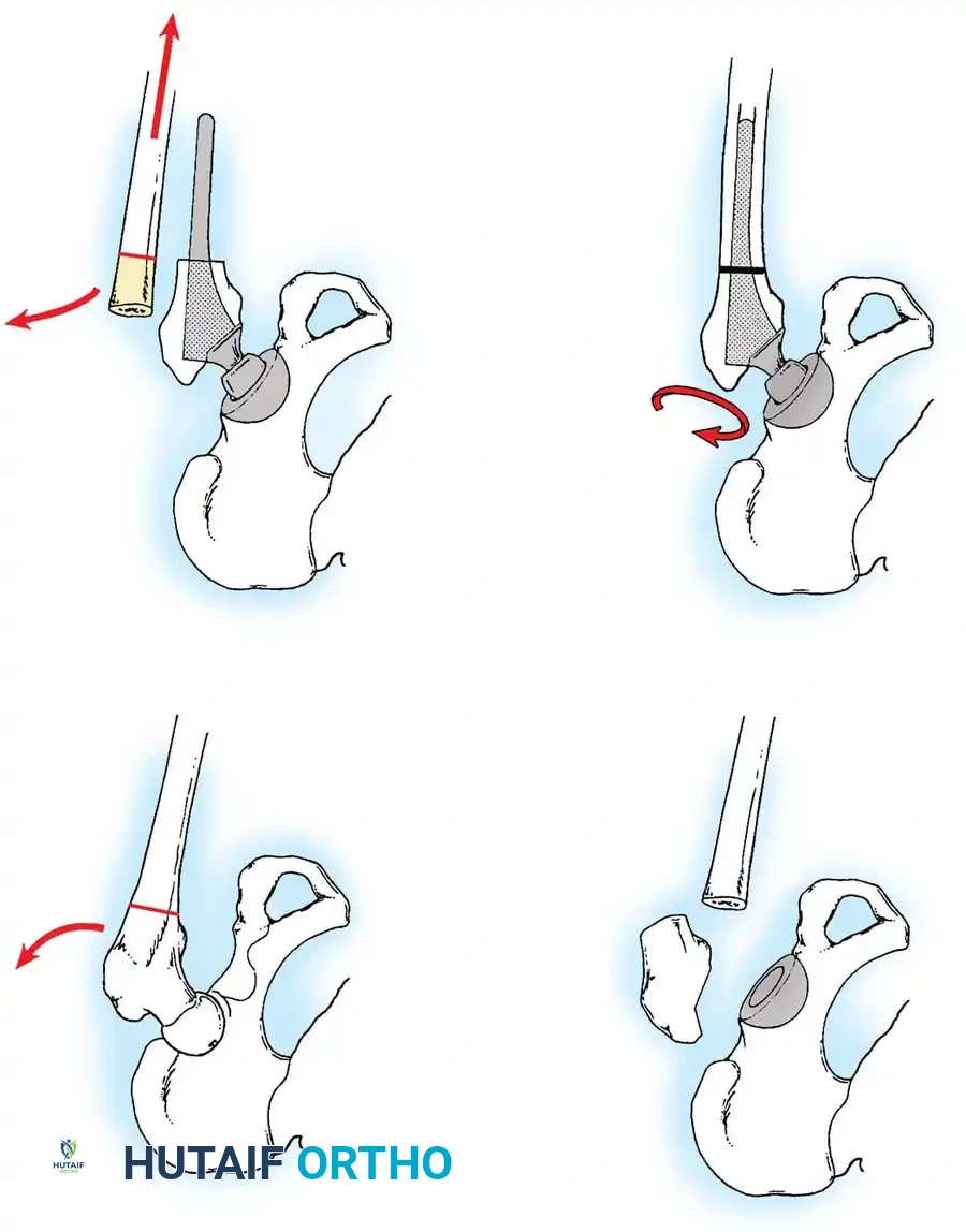 Severe osteopenia and protrusio in a patient with rheumatoid arthritis.