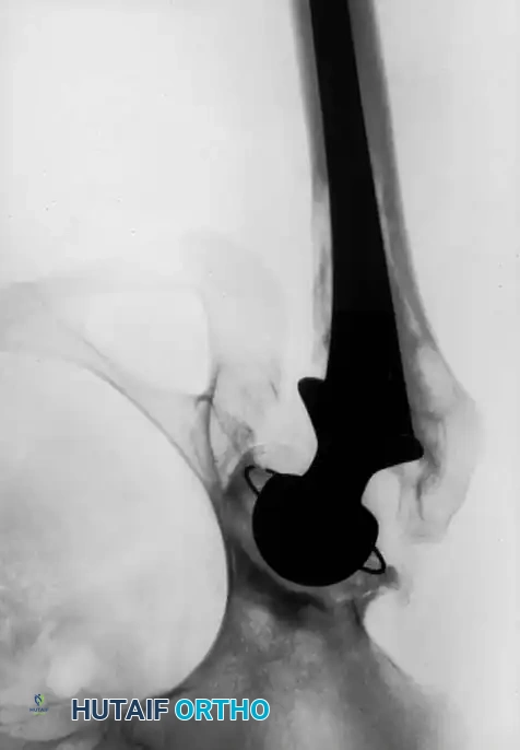 Preparation of the widened, thin-corticed femoral canal.