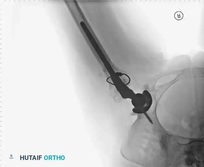 Postoperative radiograph confirming excellent fit and fill of the femoral component.