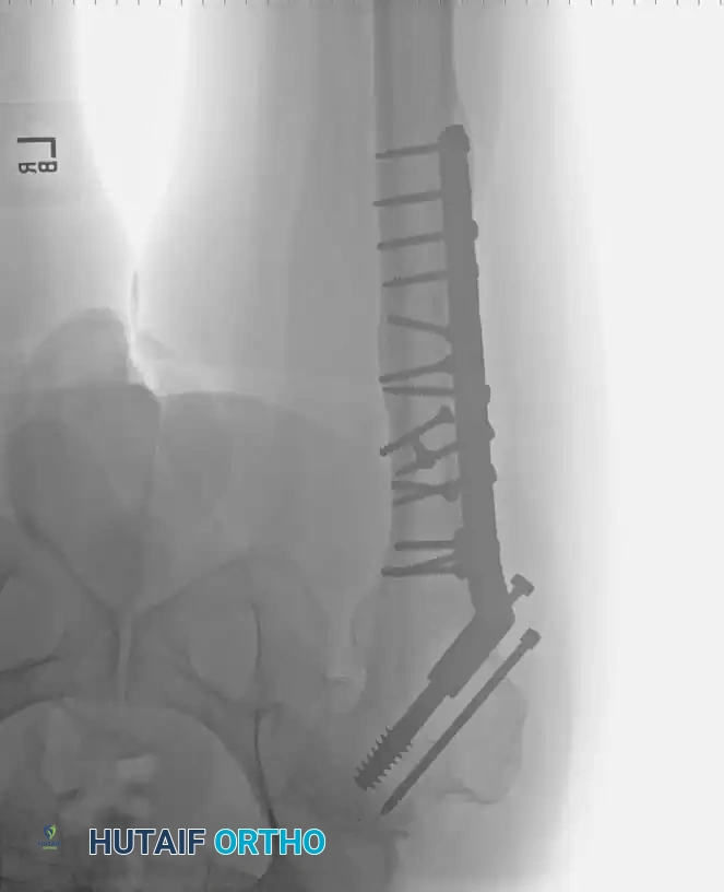 Use of a high-speed burr to clear the intramedullary canal of sclerotic graft remnants.
