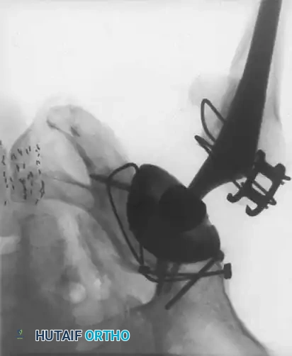 Advanced osteonecrosis with subchondral collapse and secondary arthritis.