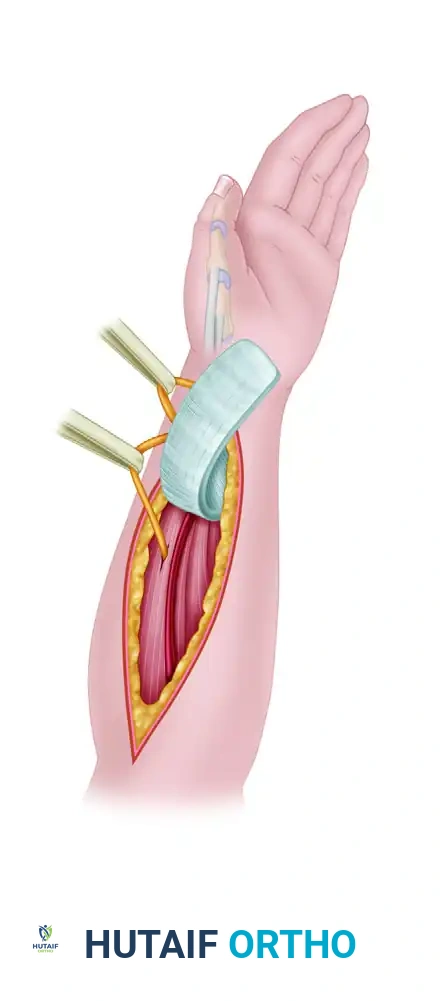 SURGICAL RELEASE OF TRIGGER FINGER Surgical Diagram