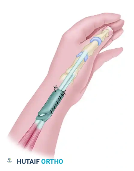 SURGICAL RELEASE OF TRIGGER FINGER Surgical Diagram