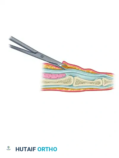 Operative Management of Trigger Finger & De Quervain Disease