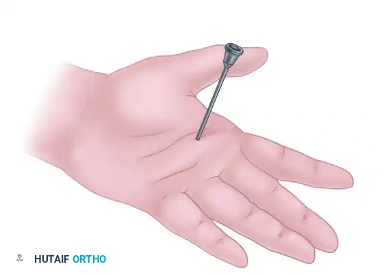 SURGICAL RELEASE OF TRIGGER FINGER Surgical Diagram
