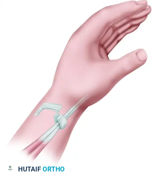 Mastering the Surgical Management of Stenosing Tenosynovitis: De Quervain Disease and Trigger Digits