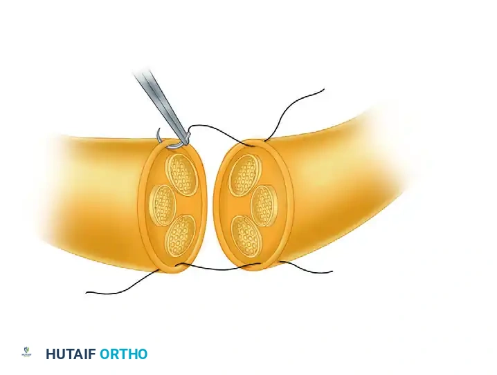SUTURE OF DIGITAL NERVES Surgical Diagram