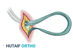 SWAN-NECK DEFORMITY Surgical Diagram