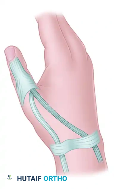 SWAN-NECK DEFORMITY Surgical Diagram