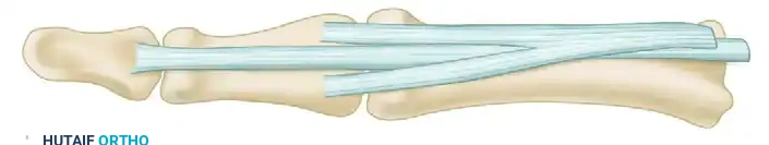 SWAN-NECK DEFORMITY Surgical Diagram