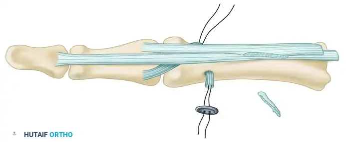 Surgical Management of Spastic Swan-Neck & Thumb Deformities