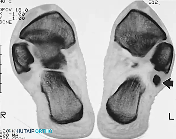 Masterclass in Peroneal Tendon Surgery: Synovectomy, Repair, and Stabilization