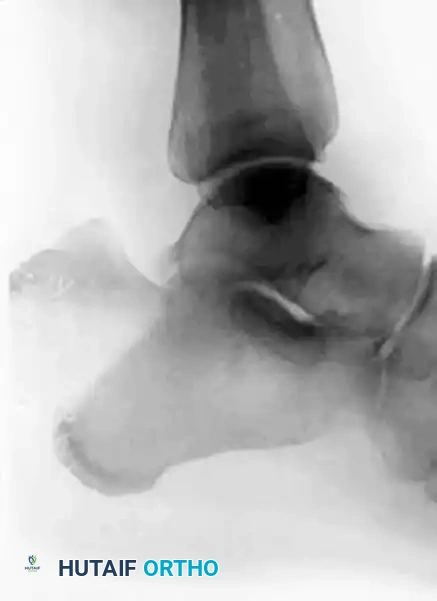 Type I Sleeve Fracture Diagram B