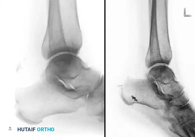 Type III Infrabursal Fracture Diagram F
