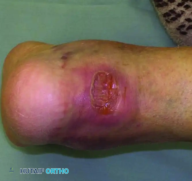 Open Wound on Posterior Heel