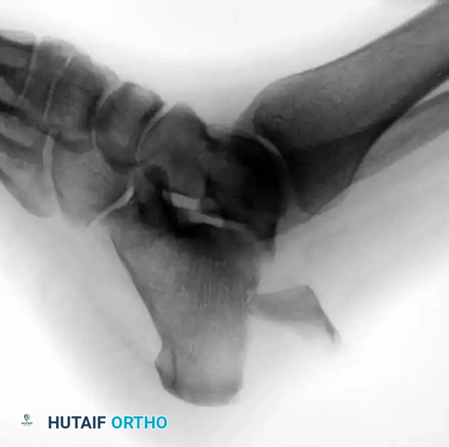 Calcaneal Avulsion with Large Fragment