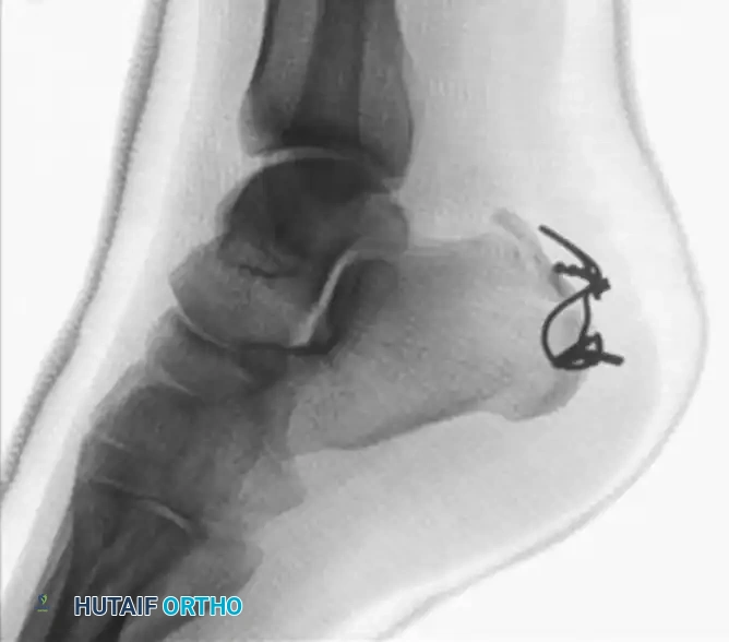 Plate and Screw Fixation B